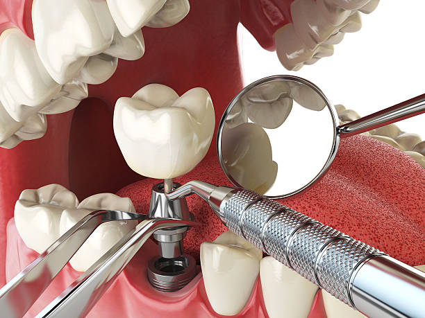 Best Emergency Tooth Extraction in Olmsted Falls, OH